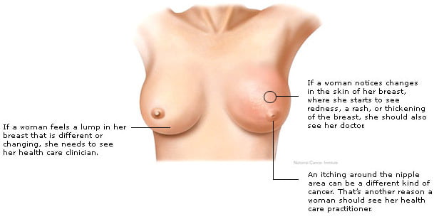 Symptoms_Of_Breast_Cancer_In_Females