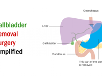 Know about Complications After Gallbladder Removal Surgery