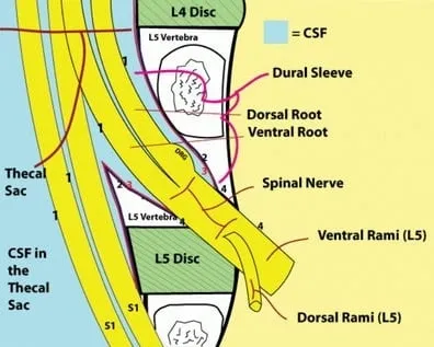 How to Treat Thecal Sac Impingement: A Comprehensive Guide